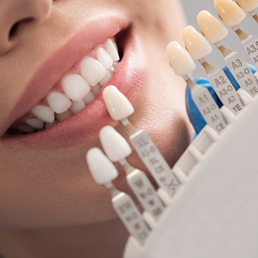 Woman's smile compared with porcelain veneer shade chart