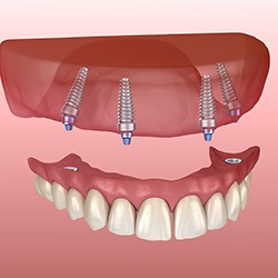 Model of implant-supported denture