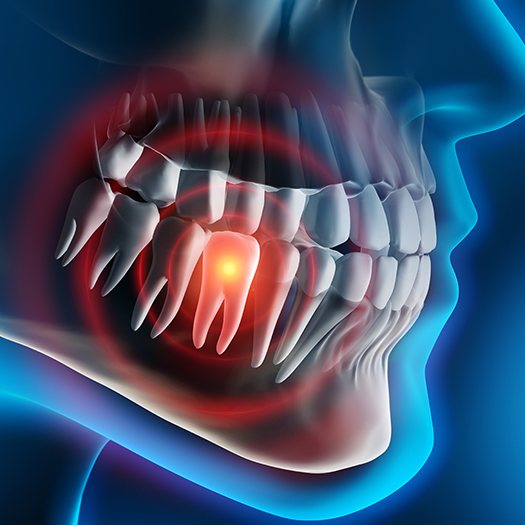 Animated smile with damaged tooth prior to tooth extraction