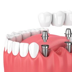 dental bridge being placed onto two implant posts