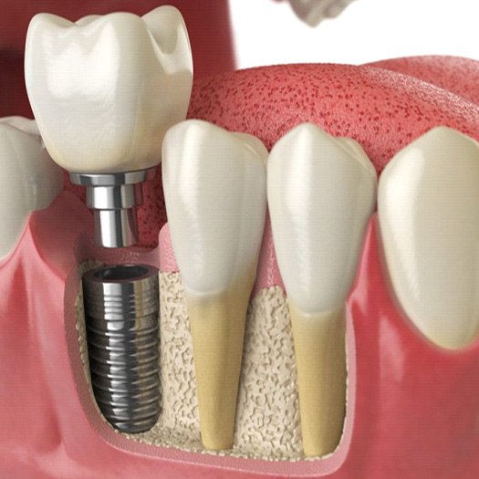 Digital illustration of a dental implant