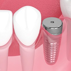 Digital illustration of dental implant with protective cap