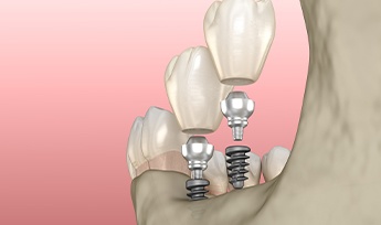 Animated mini dental implant placement