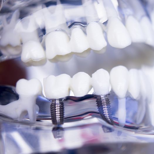 Model dental implant supported fixed bridge