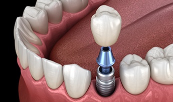 Animated dental implant supported dental crown placement