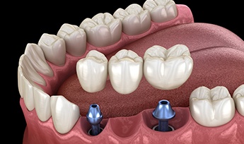 Animated dental implant supported fixed bridge placement