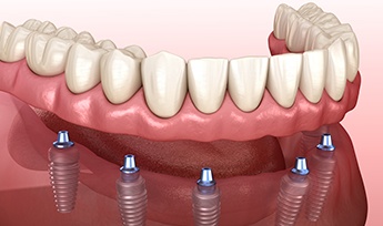 Animated dental implant supported denture placement