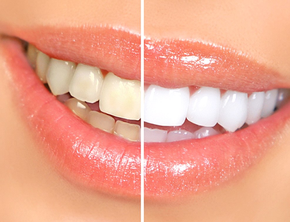 Closeup before and after comparison KOR® teeth whitening in Abingdon