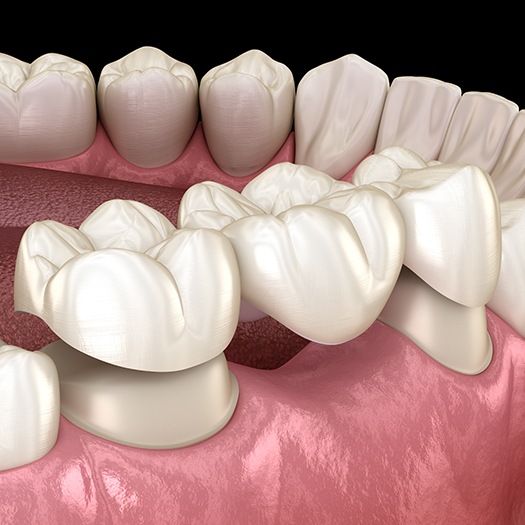 Animated dental bridge placement