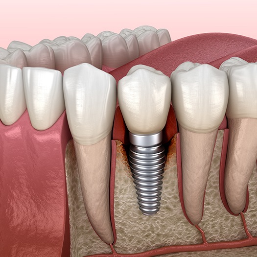 Animated dental implant supported dental crown