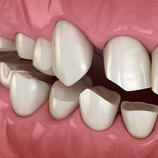 Illustration of teeth worn down due to teeth grinding in Abingdon, VA