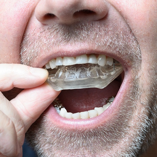 Man wearing nightguard for teeth grinding in Abingdon, VA