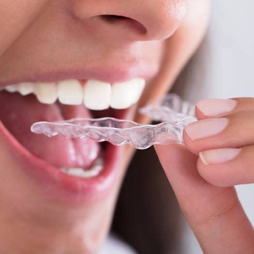 An up-close view of a person preparing to insert their Invisalign aligner