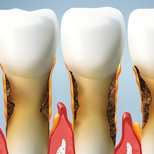 Animated smile with gum tissue recession and decay due to periodontal disease