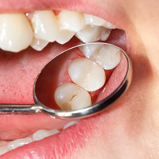 Closeup of damaged tooth in need of tooth colored filling