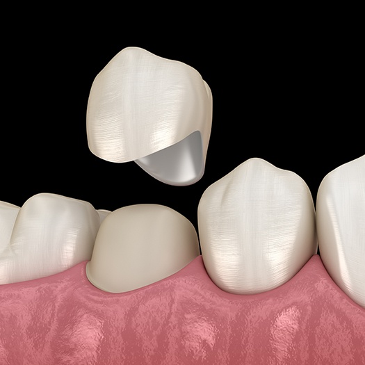 Animated dental crown placement