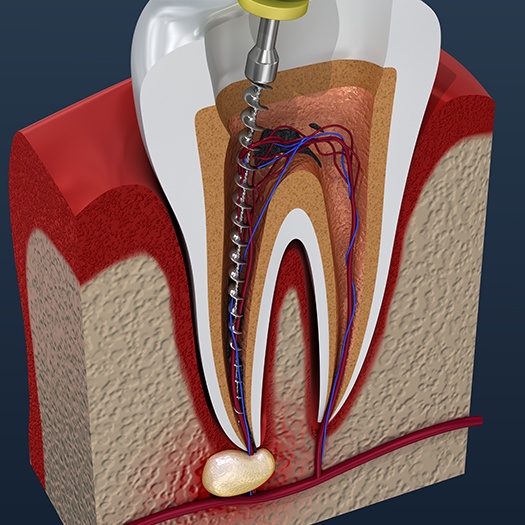 Animated tooth during root canal procedure
