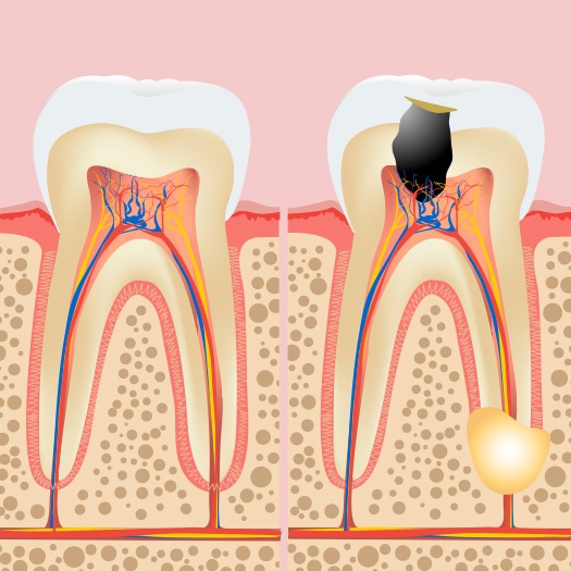 Animated tooth before and after root canal therapy