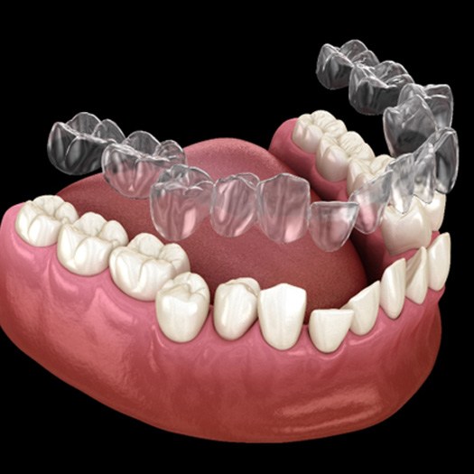 Illustration of SureSmile aligner being placed on misaligned teeth