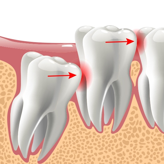 Animated smile with impacted wisdom tooth