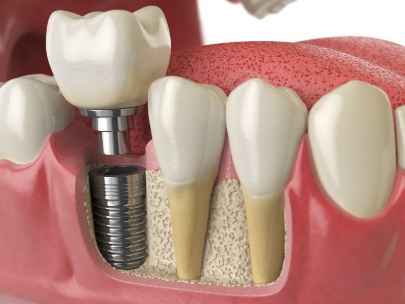 closeup of dental implant in mouth