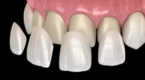 veneer installation procedure 3D illustration